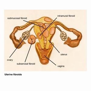 Pelvic Congestion FAQs - Sydney Fibroid Clinic